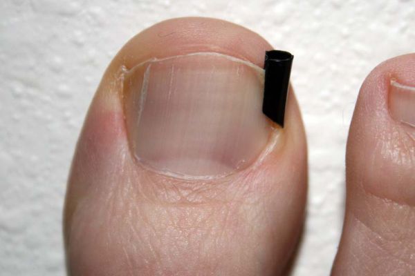 Cómo se deben tratar las uñas encarnadas al correr.